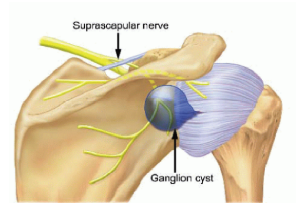 Ganglion Cyst Around Shoulder Joint Dr Rahul Bade 1005