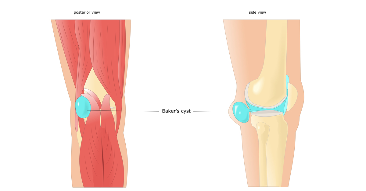Cyst Removal Doctors in Pune, India