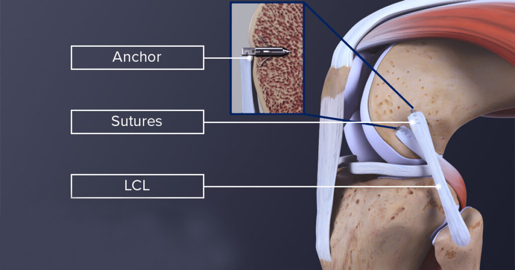 Lateral Collateral Ligament Treatment In Pune India Lateral Collateral Ligament Treatment