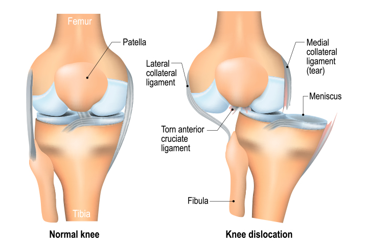 Multiligament Knee Injury Treatment in Pune, India