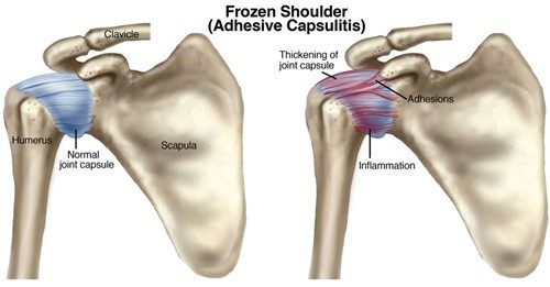 Frozen Shoulder Treatment in Pune, India