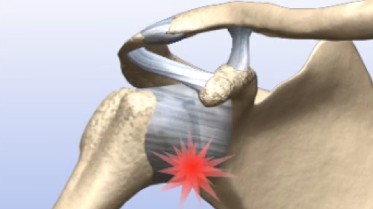 Arthoscopic Slap Repair Procedure in Pune India