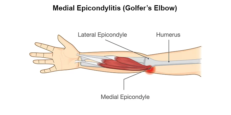 Golfers Elbow Treatment Specialist in Pune India