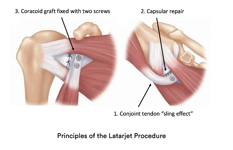 Laterjet Procedure For Shoulder Dislocation in Pune