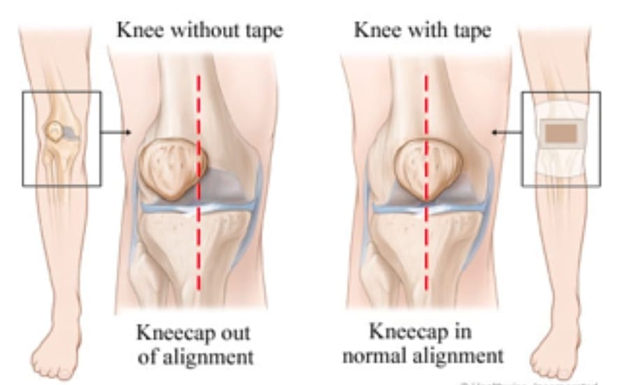Knee Cap Malalignment Treatment in Pune, India
