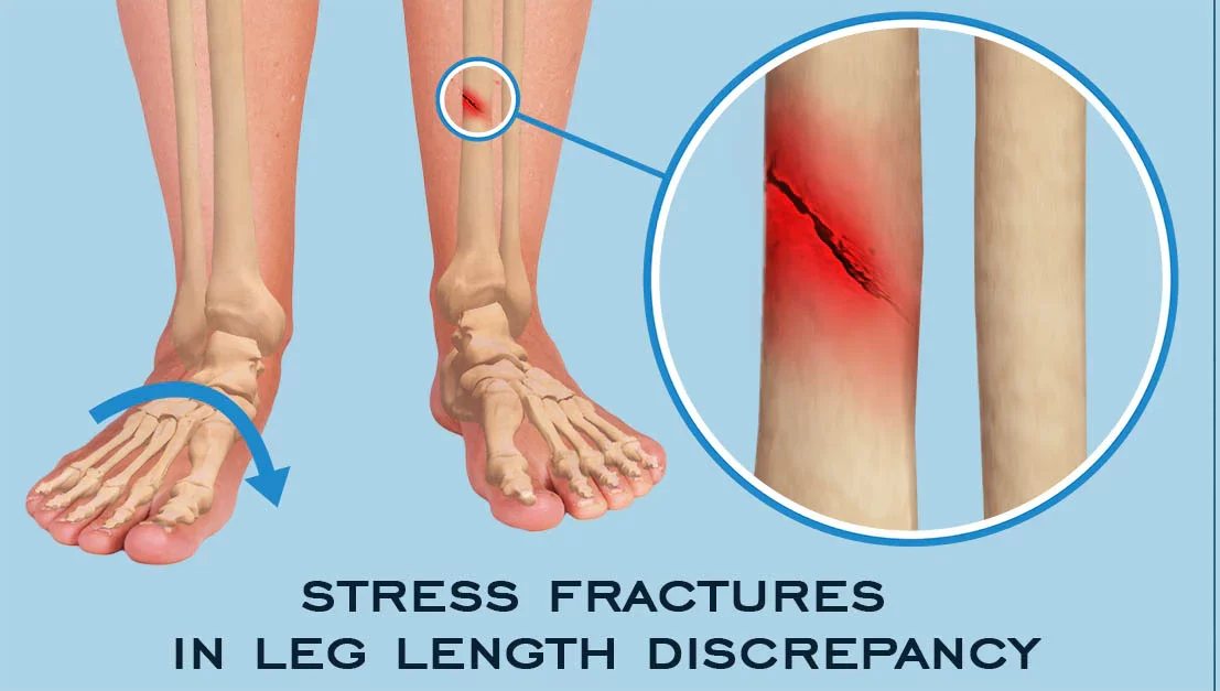Stress Fracture Treatment Doctors in Pune India