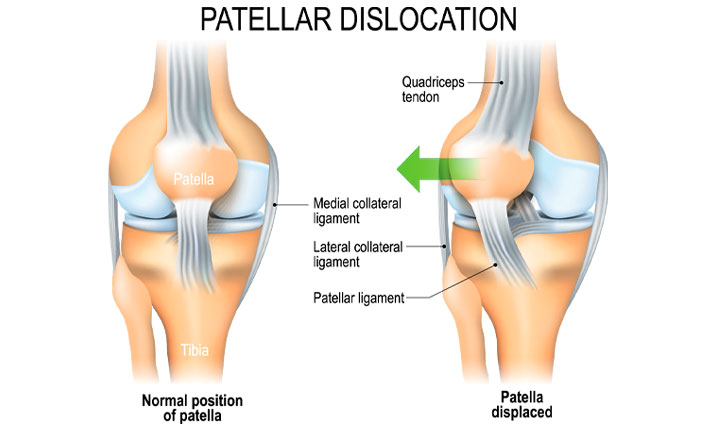 Kneecap Dislocation Treatment in Pune, India