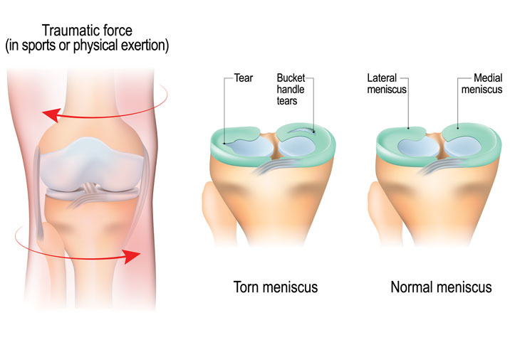 Lateral Meniscus injuries Treatment in Pune