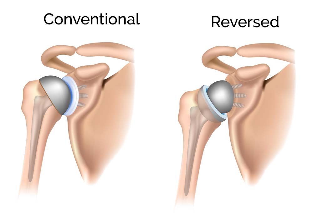 Reverse Shoulder Replacement Surgery Doctors in Pune