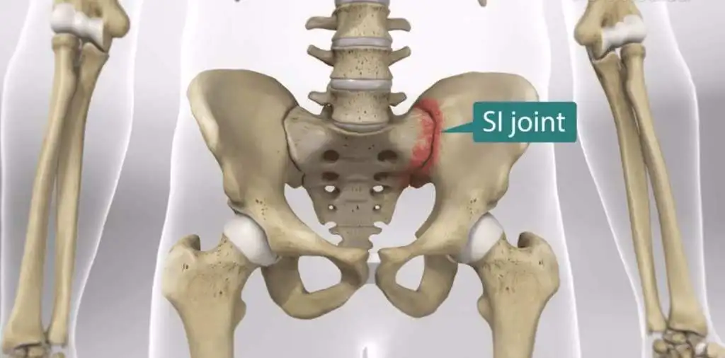 Sacroiliitis Joint Pain Treatment in Pune India