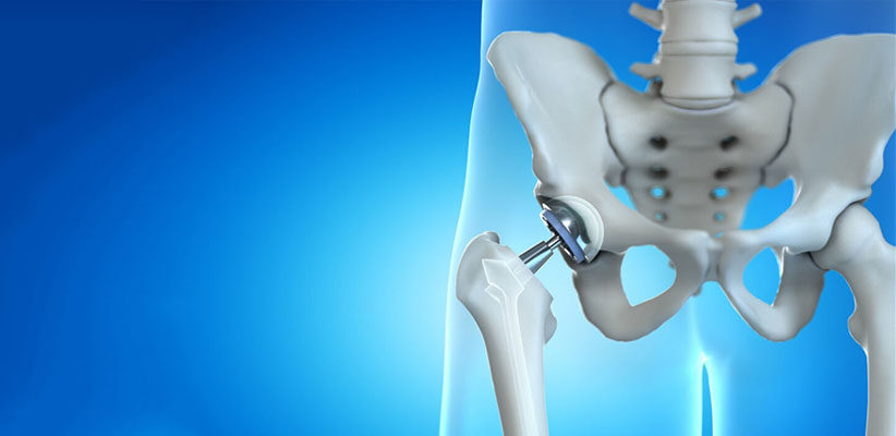 Hip Replacement Surgeon in Pune