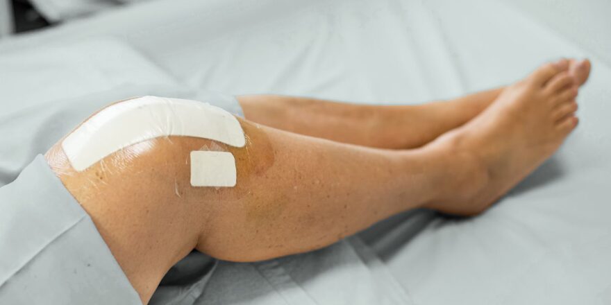 A Guide to Knee Replacement Surgery: What to Expect
